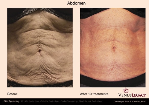 RF Body Sculpting In Sylva NC Safe Fat Reduction Solution RF Body Sculpting In Sylva NC Safe Fat Reduction Solution